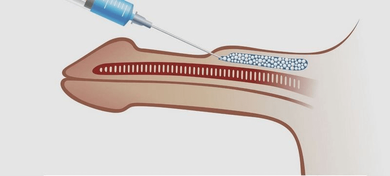 injekció a péniszbe